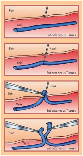 Sclerotherapy and mini-invasive surgery